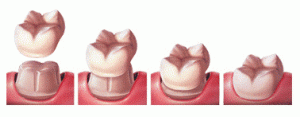 dental-crowns