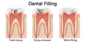 dental_filling